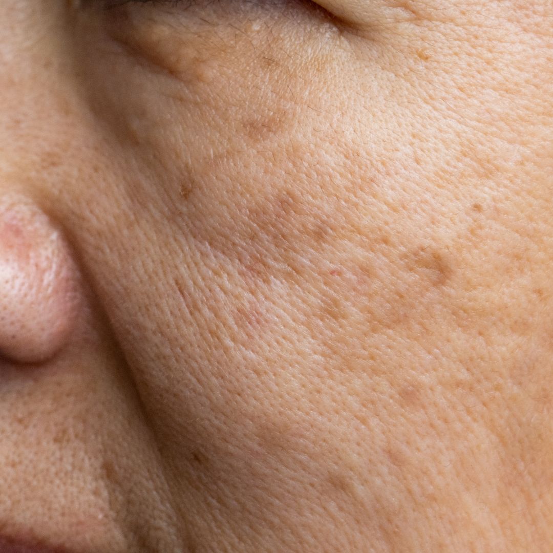 lumière pulsée bordeaux