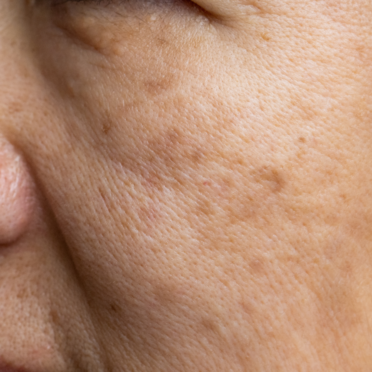 taches visage bordeaux