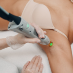 epilation laser bordeaux